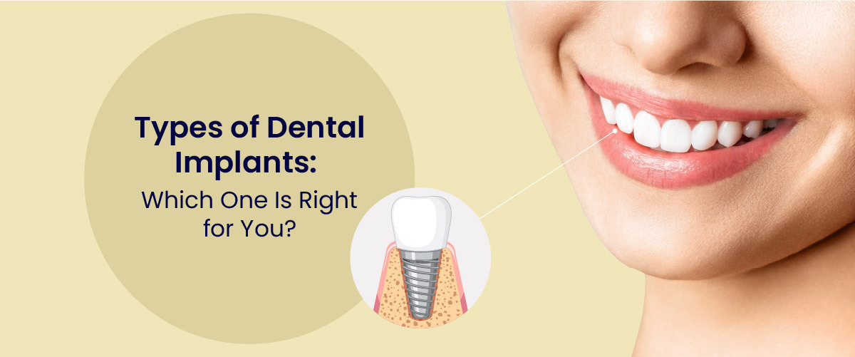 Types of dental implants
