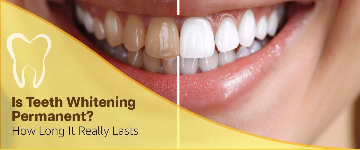 Is Teeth Whitening Permanent