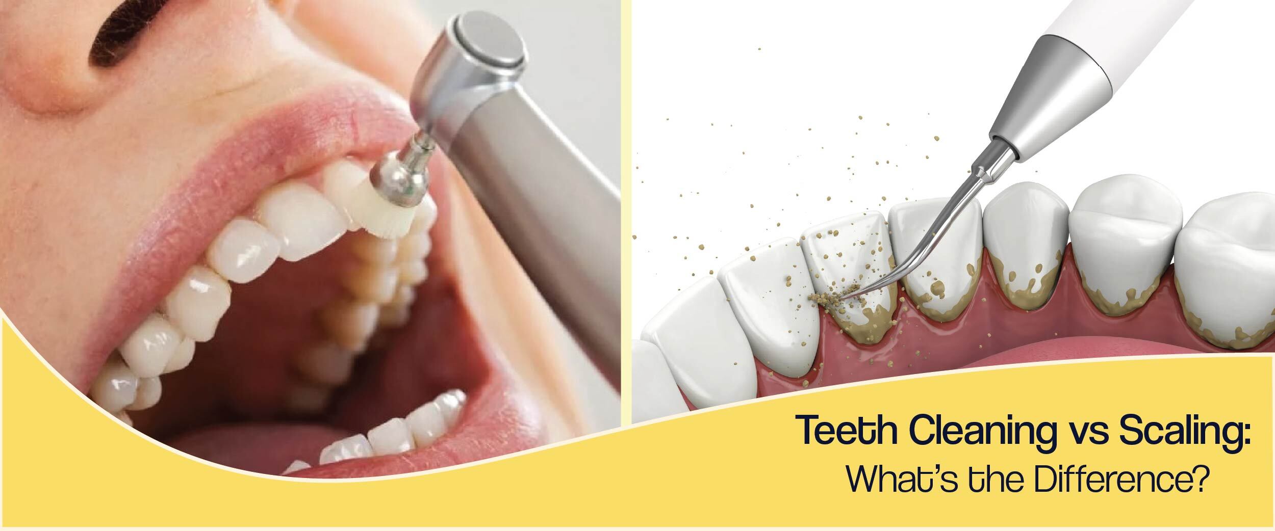 Teeth Cleaning vs Scaling